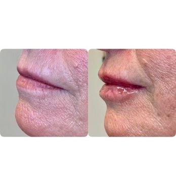 Alani Skin MD - Lip volume - Medical Spas Near Me - Phoenix, Arizona