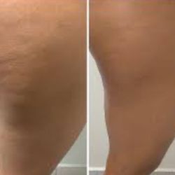 The 360 - Cellulite Reduction/Skin Tightening results
