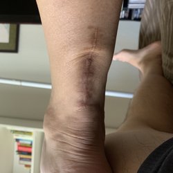 Louis Caputo, DPM - 2 years after ruptured achilles surgery