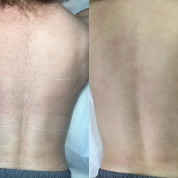 BrightCraft Med Spa In Burbank - Before/Right after the laser hair removal treatment - Medical Spas Near Me - Burbank, California