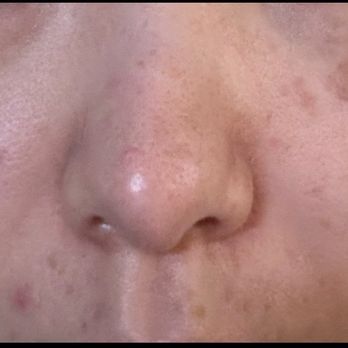 TROIAREUKE California - Before - Skin Care Near Me - Buena Park, California