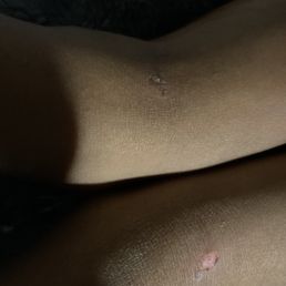 A rug burn