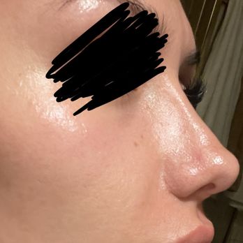 Ari Hyman, MD - Lumpy right side - Cosmetic Surgeons Near Me - Encino, California Ari Hyman, MD - Lumpy right side - Cosmetic Surgeons Near Me - Encino, California
