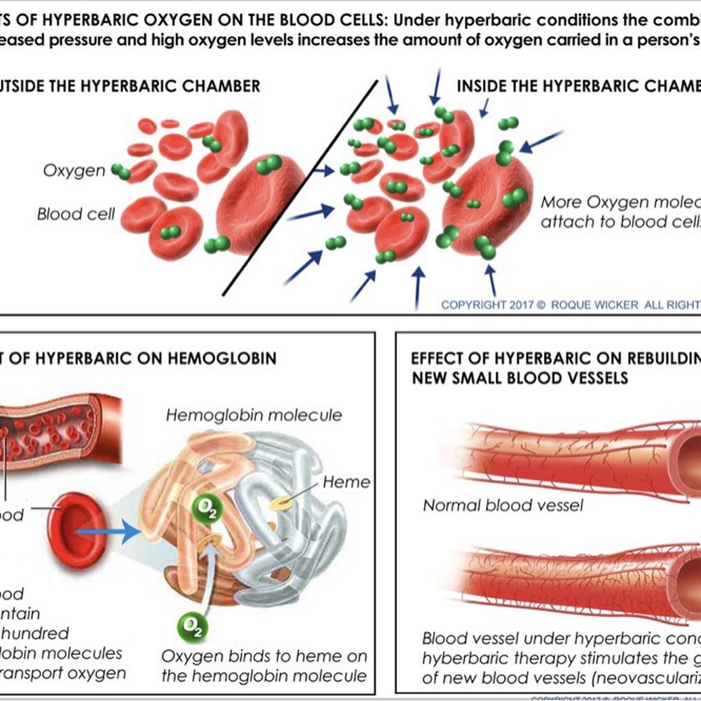 The benefits of hyperbaric oxygen therapy! The benefits of hyperbaric oxygen therapy!