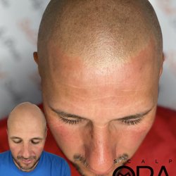 Scalp Mora Pigmentation