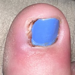 Lee Nails & Spa - Orlando - Infected toe from a pedicure, a week later