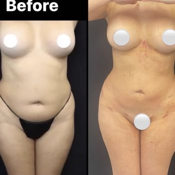 Samuel Golpanian - Before and 4 days post op - Plastic Surgeons Near Me - Beverly Hills, California