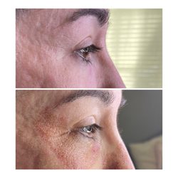 The Touch - Plasma Skin Tightening Under Eye and Crows Feet Treatment - Before  Immediately After
