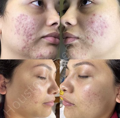 ACNE - Christine Acne & Blemish Skincare by Christina – Cleansers, Spot