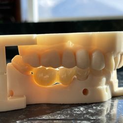 Professional Dental Springville - Dr. Anderson made a wonderful bridge to restore missing teeth.