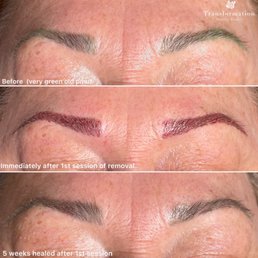 Original green eyebrows  After first removal process Healed up