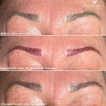 Transformation beauty studio - Original green eyebrows  After first removal process Healed up - Permanent Makeup Near Me - San Diego, California