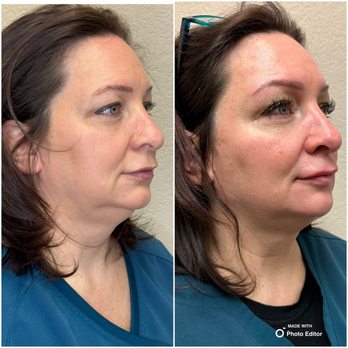 Open Door Med Spa - Cellenis Derma Gel PRP TX - Skin Care Near Me - Mansfield, Texas