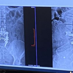 Erik C Spayde, MD - Exactly 6 months post XLIF fusion, artificial disc, 2 bone spur removals and a host of other fun things.