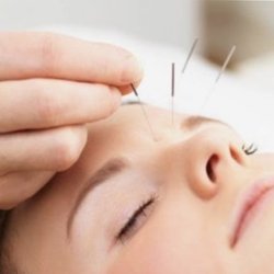 Oasis Palisades - Facial Acupuncture at Oasis Palisades