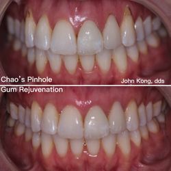 Better Living through Dentistry - Chao's Pinhole Gum Rejuvenation technique