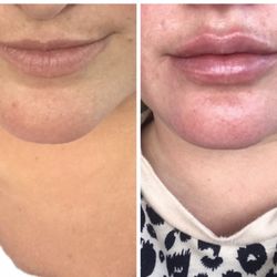 Reflections Medical - Lip filler