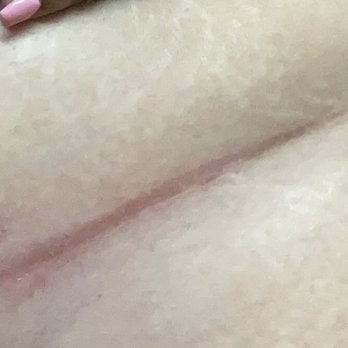 PSW Acupuncture Clinic - This is the scar I was left with, that I now have to be purchasing creams and gels to get rid of. - Acupuncture Near Me - San Jose, California PSW Acupuncture Clinic - This is the scar I was left with, that I now have to be purchasing creams and gels to get rid of. - Acupuncture Near Me - San Jose, California