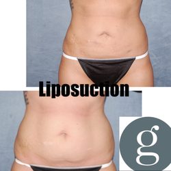 David Godat, MD - Liposuction Before & After