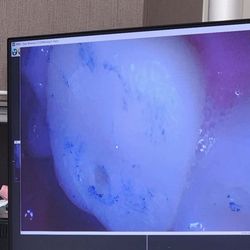 Nu Smile Family Dentistry - This is the picture of the hole in my tooth that the next dentist place took.