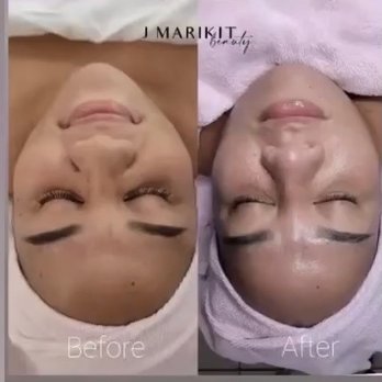 J Marikit Beauty - My before and after pictures from Joanna - Estheticians Near Me J Marikit Beauty - My before and after pictures from Joanna - Estheticians Near Me