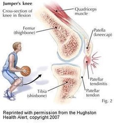Liza Shiff, MD - Simple explanations for chronic issues- basketball knees