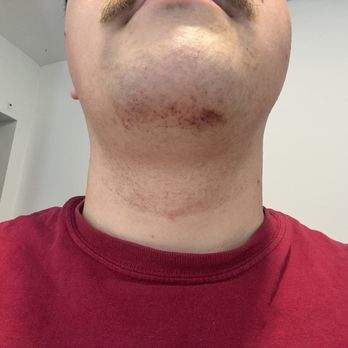 The Spot Barbershop - Pinecrest - Injured post shave face - Barbers Near Me - Pinecrest, Florida The Spot Barbershop - Pinecrest - Injured post shave face - Barbers Near Me - Pinecrest, Florida
