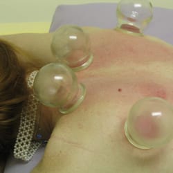 Cupping