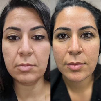 Regenerize Me - Lifting with Agnes Precision RF - Skin Care Near Me - Northville, Michigan