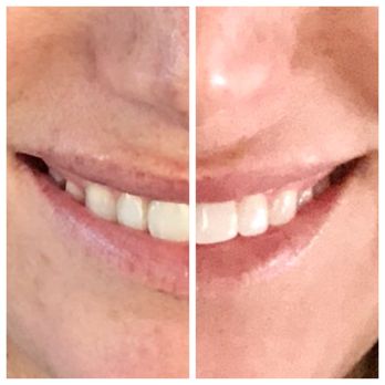 Company Andrea M DDS - Phenomenal teeth whitening! - General Dentistry Near Me - Canton, Ohio Company Andrea M DDS - Phenomenal teeth whitening! - General Dentistry Near Me - Canton, Ohio