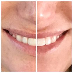 Company Andrea M DDS - Phenomenal teeth whitening!