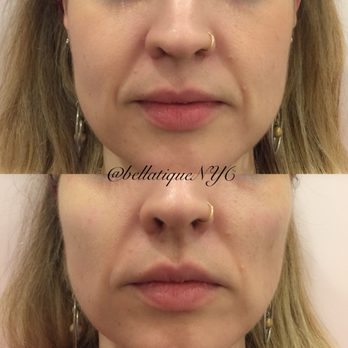 Bellatique NYC - Cheek Augmentation - Medical Spas Near Me - New York, New York Bellatique NYC - Cheek Augmentation - Medical Spas Near Me - New York, New York