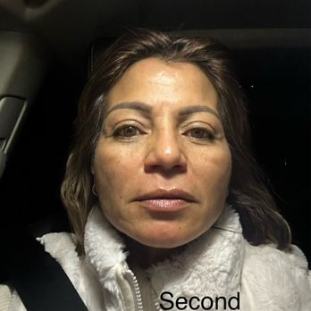 Opal MD Aesthetics - Second Hifu treatment - Medical Spas Near Me - Los Angeles, California