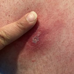 Fulton County Hospital - Tick bite infection looking better, fever only 103 - 104 new