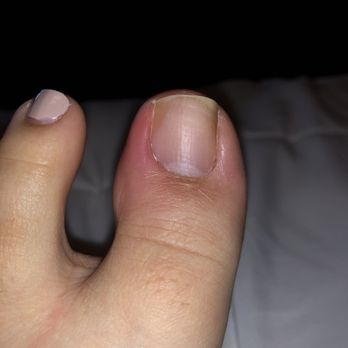 Vida Nail Spa - Updated photo I took my nail polish off so that I can see the condition of my nail. It is a lot more painful and super swollen and red now. - Nail Salons Near Me - Oakley, California Vida Nail Spa - Updated photo I took my nail polish off so that I can see the condition of my nail. It is a lot more painful and super swollen and red now. - Nail Salons Near Me - Oakley, California