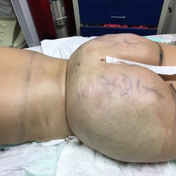 Ayman Shahine, MD - Dr Ayman Shahine is the best liposuction, fat transfer and Brazilian butt lift doctor  in the world   His work speaks for itself