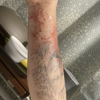 HCA Florida Kendall Hospital - Second time no medicine given and created hives, the hives started leaking - Hospitals Near Me - Miami, Florida HCA Florida Kendall Hospital - Second time no medicine given and created hives, the hives started leaking - Hospitals Near Me - Miami, Florida