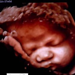 Precious Faces In 3D - Baby in 3D at 37w0d gestation