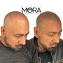 Scalp Mora Pigmentation