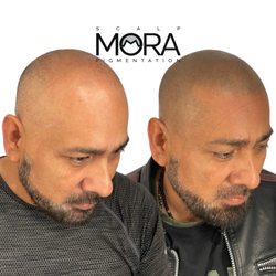 Scalp Mora Pigmentation - Huge transformation for this client after a few sessions with us