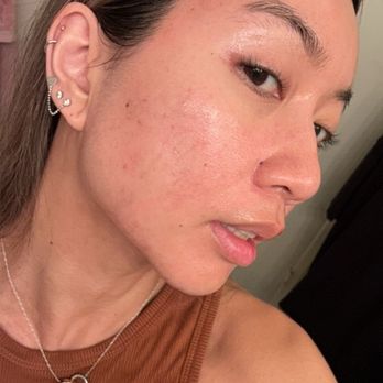 TROIAREUKE California - Before Troipeel - redness, acne scars - Skin Care Near Me - Buena Park, California TROIAREUKE California - Before Troipeel - redness, acne scars - Skin Care Near Me - Buena Park, California