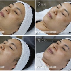 Oasis Skin Clinic - Hyperpigmentation treatment before & after (1st~4th week)