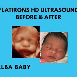 3D 4D Ultrasound Flatirons Prenatal Imaging - Before & After!