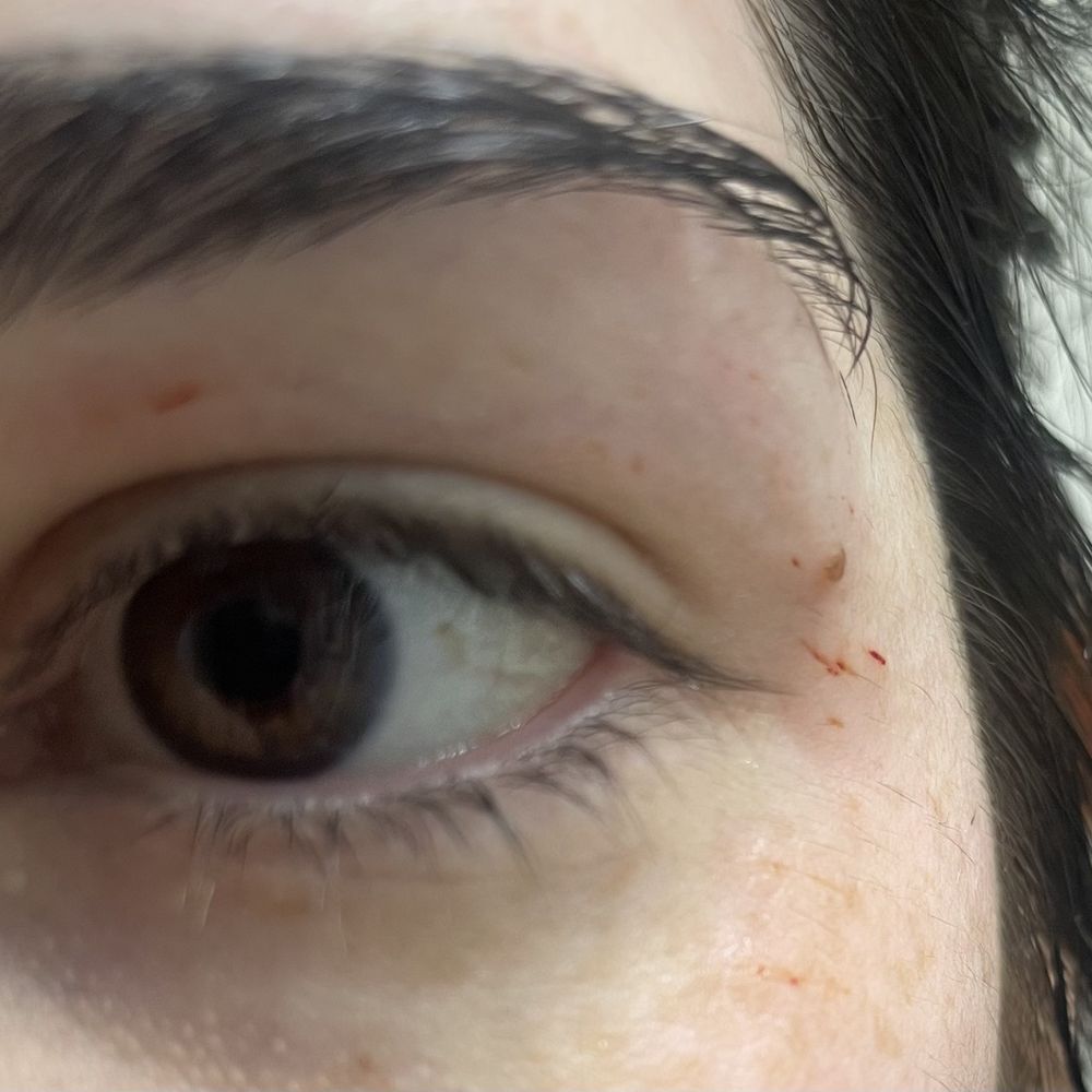 Eye Candy Waxing & Threading Brow Salon - Cuts on my cheekbone, near my temple, and under my brow near my eye. - Waxing Near Me - Dallas, Texas Eye Candy Waxing & Threading Brow Salon - Cuts on my cheekbone, near my temple, and under my brow near my eye. - Waxing Near Me - Dallas, Texas
