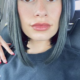 2 weeks post toxin treatment ( dysport in forehead ) 5 days post lip filler ( kysse ) 2 weeks post toxin treatment ( dysport in forehead ) 5 days post lip filler ( kysse )