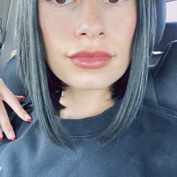 The Injection Room - 2 weeks post toxin treatment ( dysport in forehead ) 5 days post lip filler ( kysse ) - Medical Spas Near Me - San Antonio, Texas The Injection Room - 2 weeks post toxin treatment ( dysport in forehead ) 5 days post lip filler ( kysse ) - Medical Spas Near Me - San Antonio, Texas
