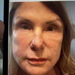 After Botox Treatment