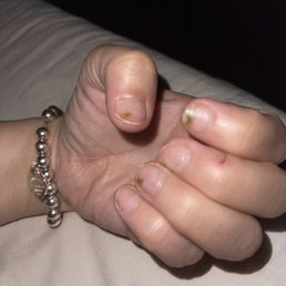3 of my nails with fungus 3 of my nails with fungus