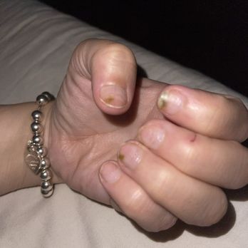 Elegant Nails & ILash Studio - 3 of my nails with fungus - Nail Salons Near Me - Ontario, California Elegant Nails & ILash Studio - 3 of my nails with fungus - Nail Salons Near Me - Ontario, California