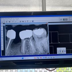 Chang Andy, DDS - Look at how beautiful my NEW ROOT CANAL is!!! I'm so so happy! I'm literally crying!